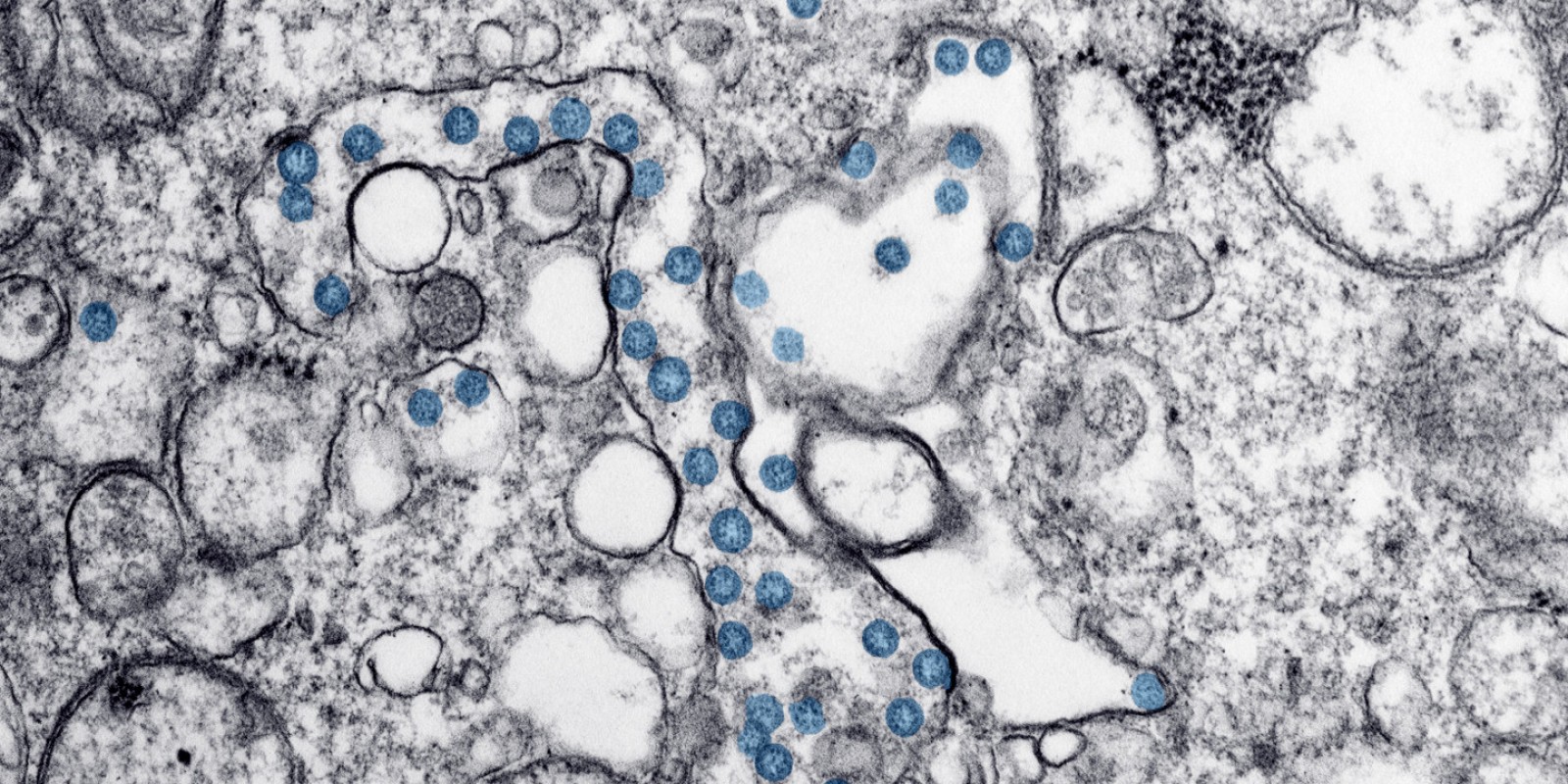  Image au microscope d'un cas de COVID-19